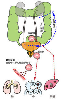 大腸がんが転移