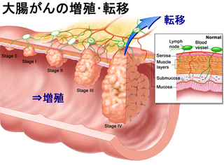 大腸がんのステージ2