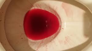 大腸がんの血便